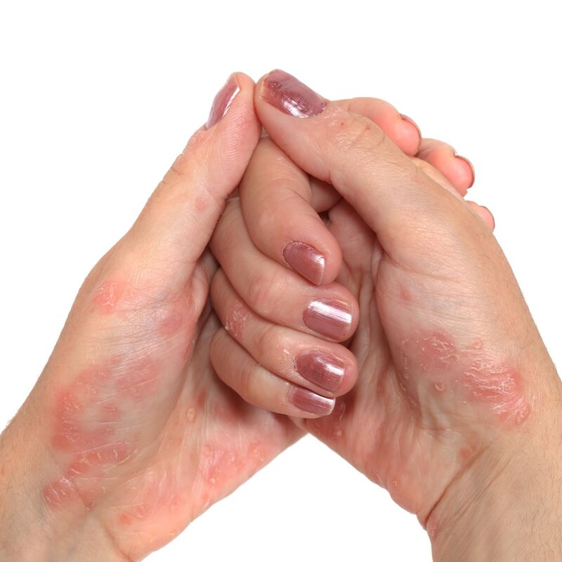 Curare La Psoriasi